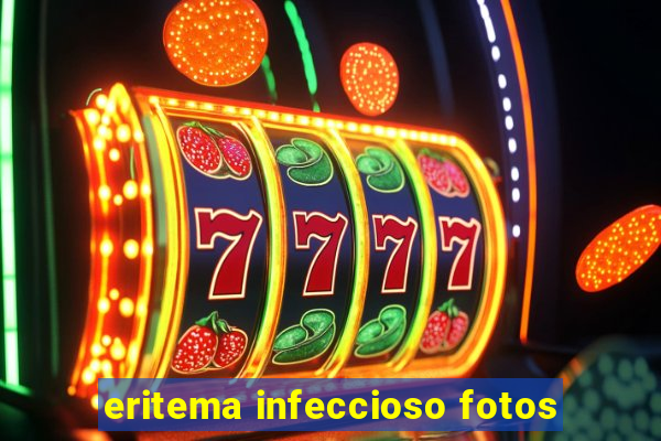 eritema infeccioso fotos